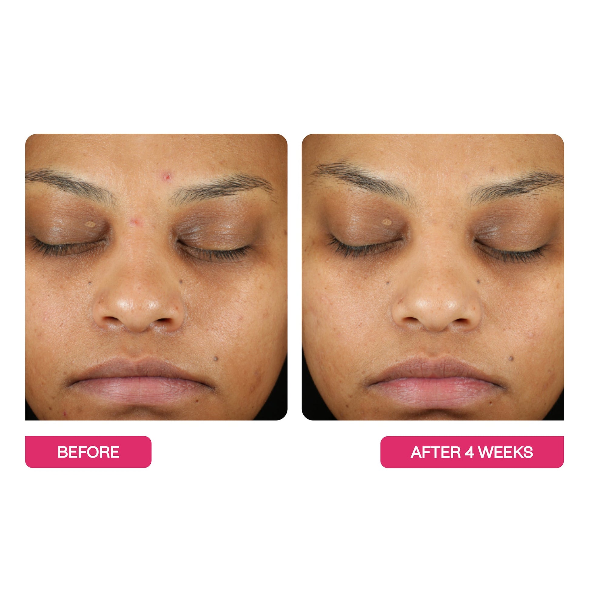 Universal Triple Action Peel Pads 10 Pack