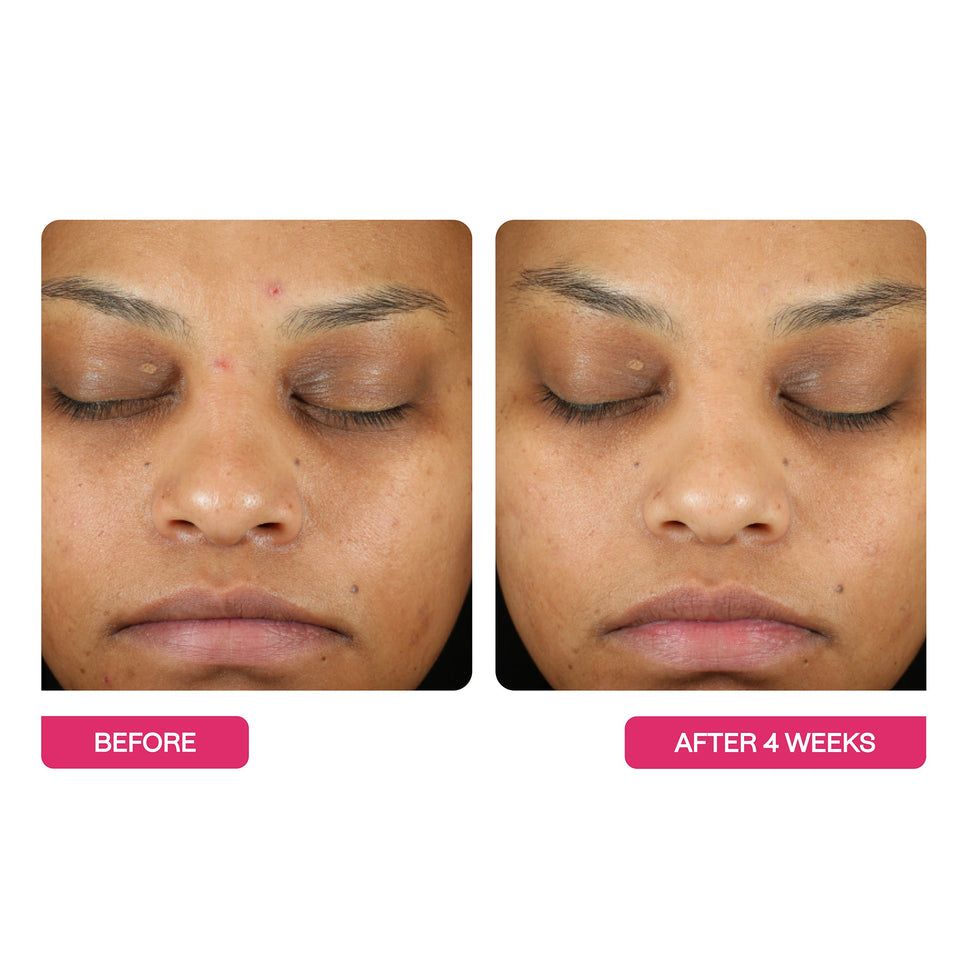 Universal Triple Action Peel Pads 10 Pack