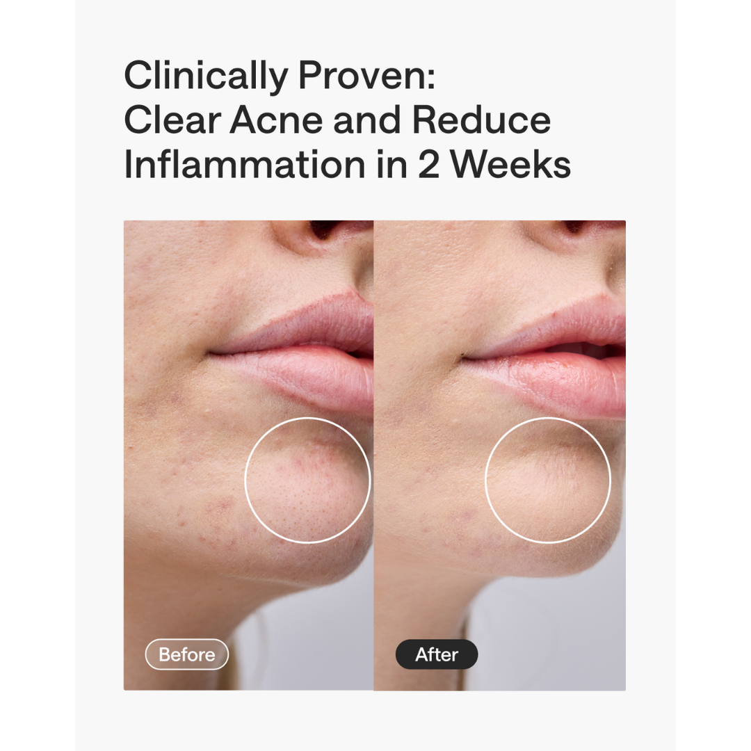 Before and after comparison of acne on a person's face with text claiming clinical proven results.